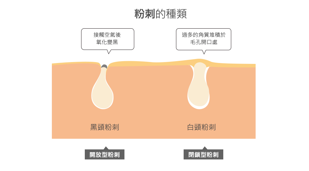 粉刺的種類