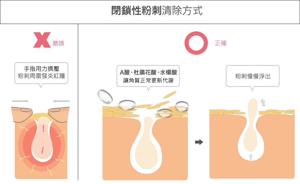 閉鎖性粉刺正確清除方式