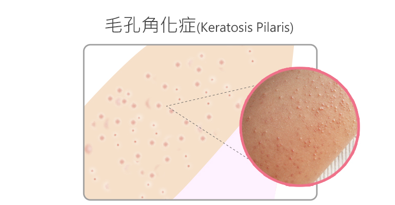 身體痘痘