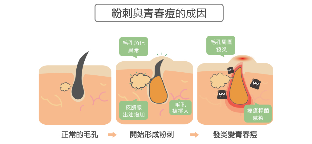 粉刺和青春痘的成因