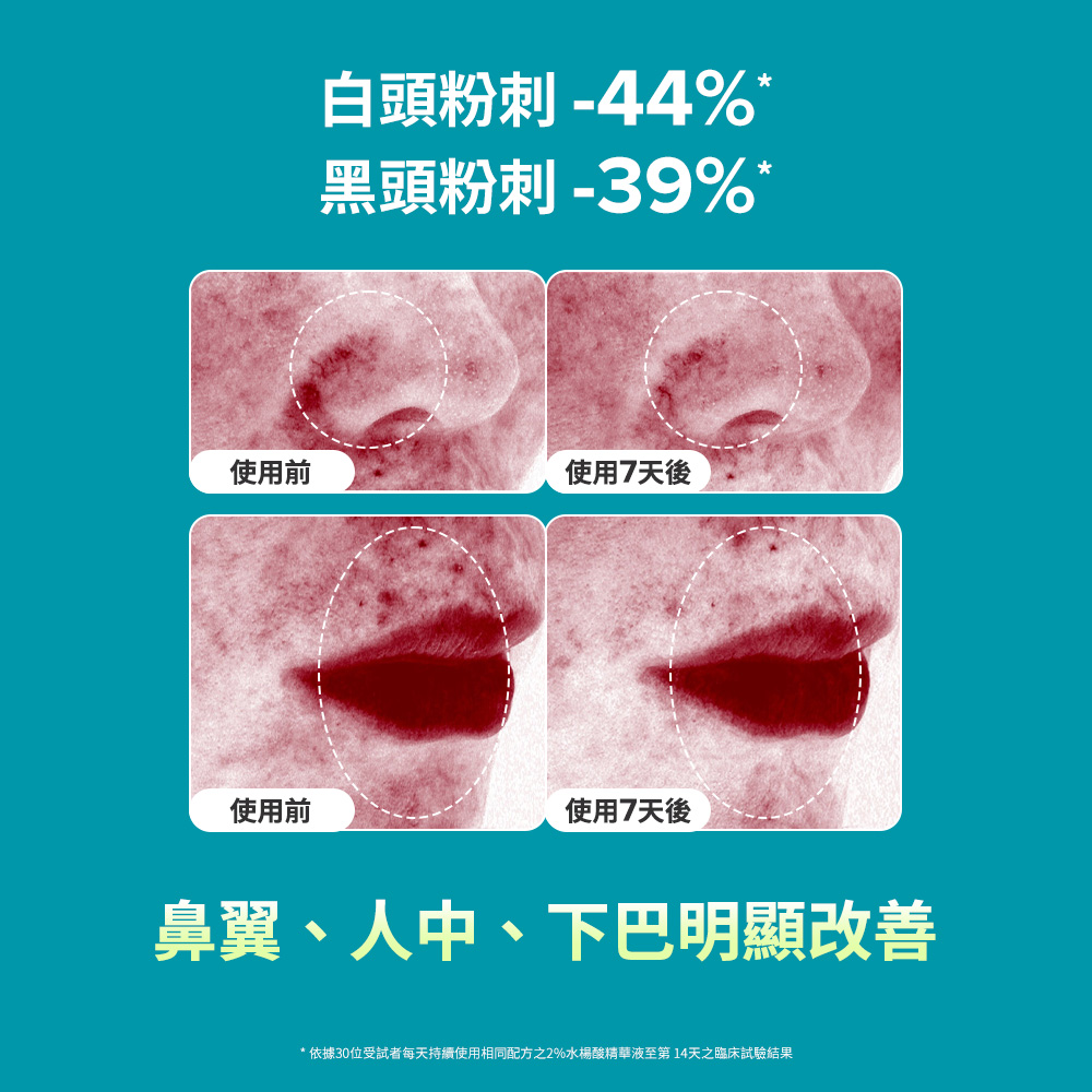 白頭粉刺-43% 黑頭粉刺-39%